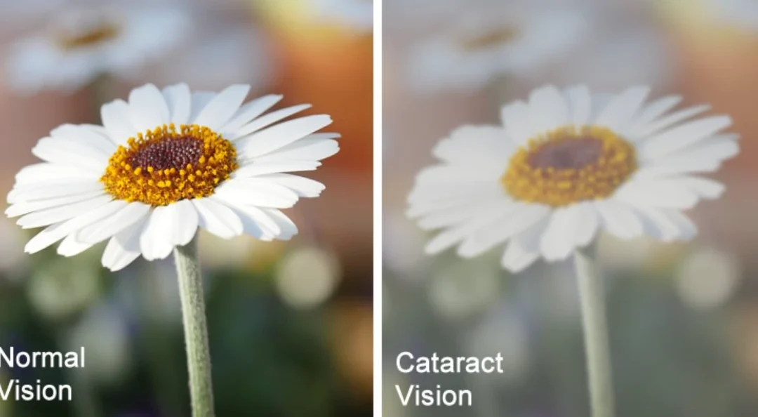 Cost of Cataract Surgery in Mumbai: A Complete Guide