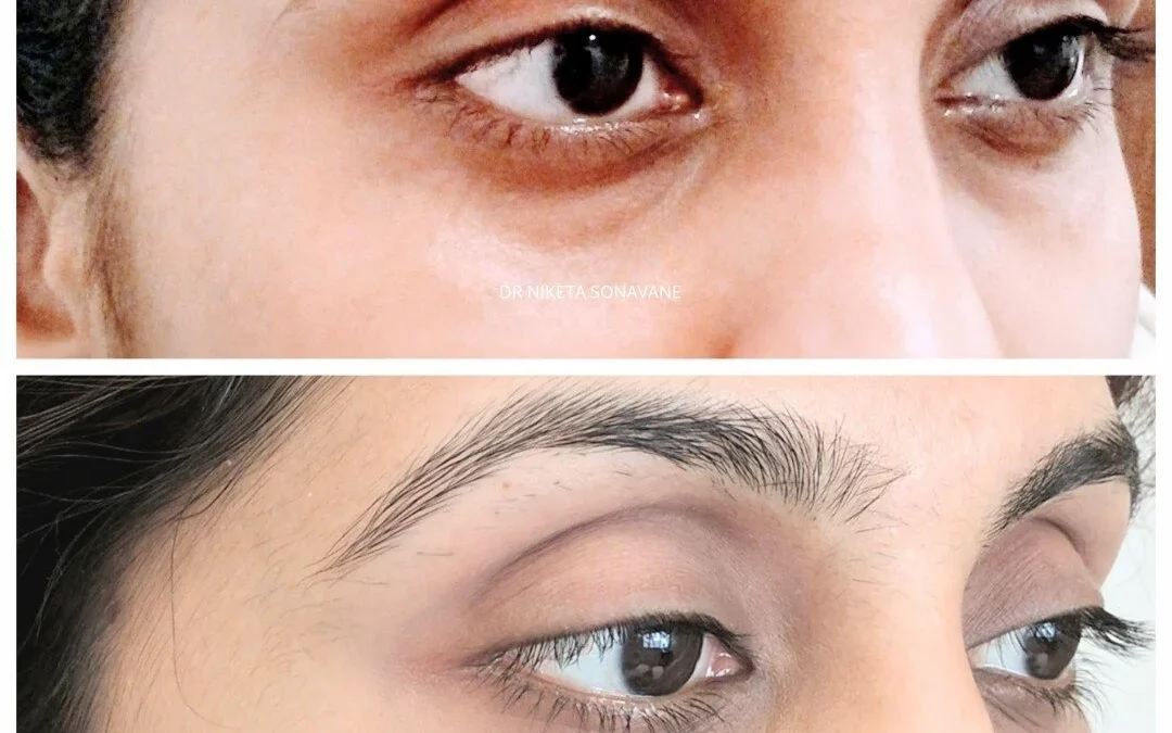 Dark Circle Removal in Mumbai – Advanced Under-Eye Treatments by Dr. Niketa Sonavane