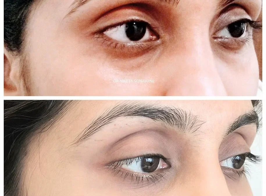 Dark Circle Removal in Mumbai: Effective Treatments for Brighter, Youthful Eyes by Dr. Niketa Sonavane