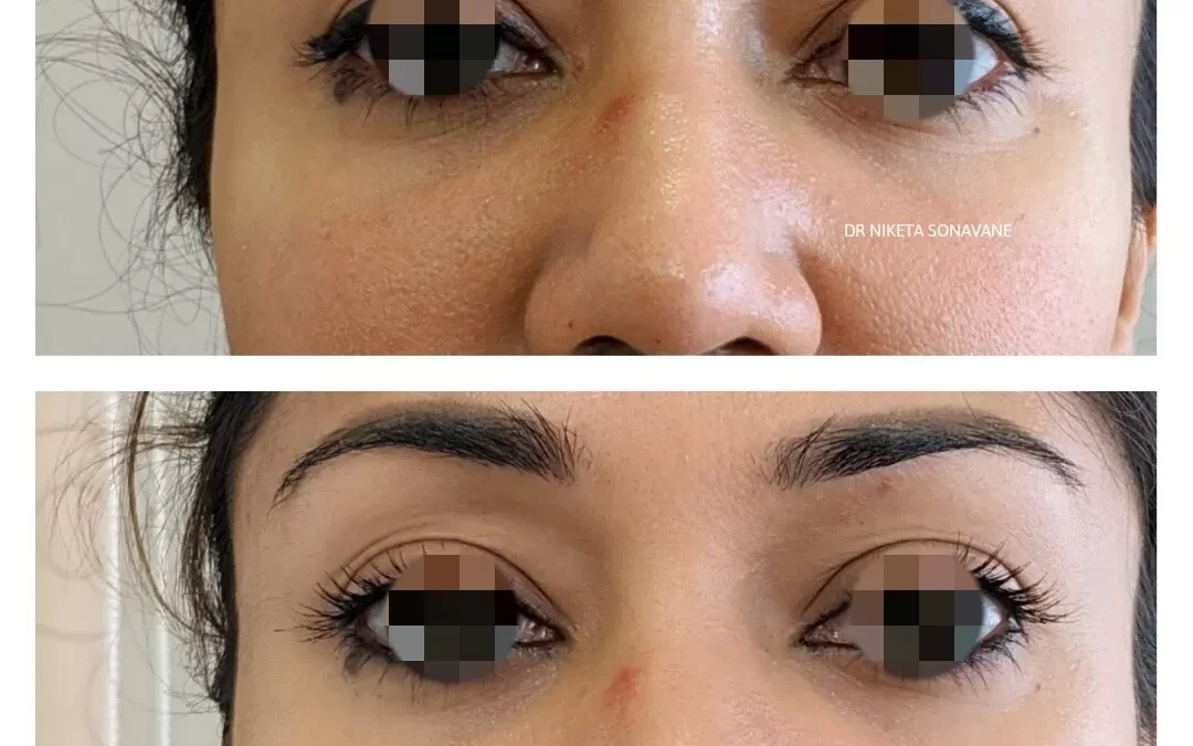 Open Pores Treatment: Achieve Smooth, Refined Skin with Dr. Niketa Sonavane