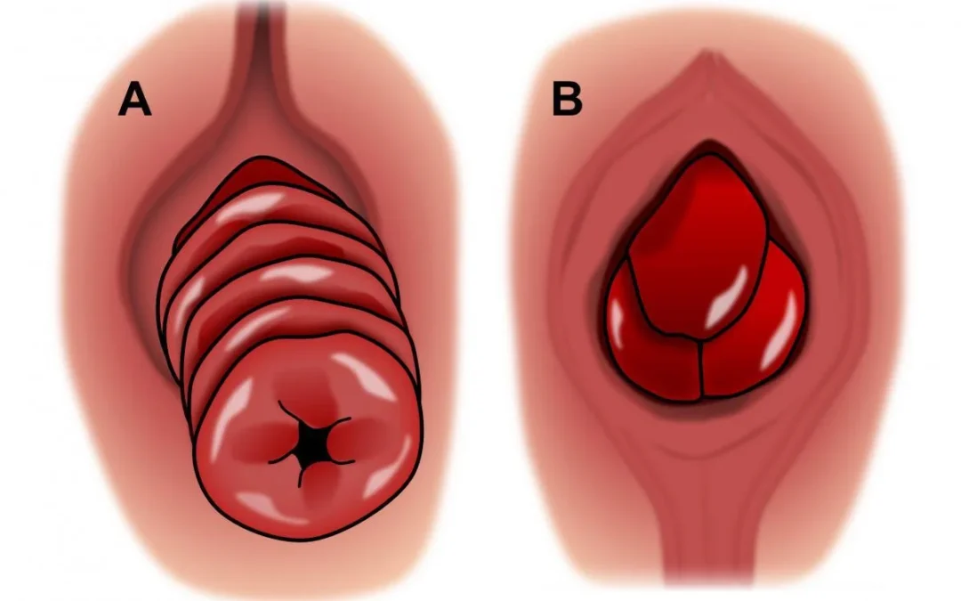 Rectal Prolapse Treatment Mumbai: Understanding Symptoms, Diagnosis, and Modern Surgical Care