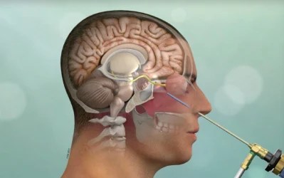 Awake Brain Tumor Surgery