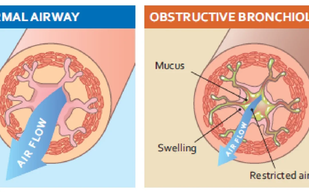 COPD Doctor in Mumbai – Comprehensive Respiratory Care with Dr. Parthiv Shah
