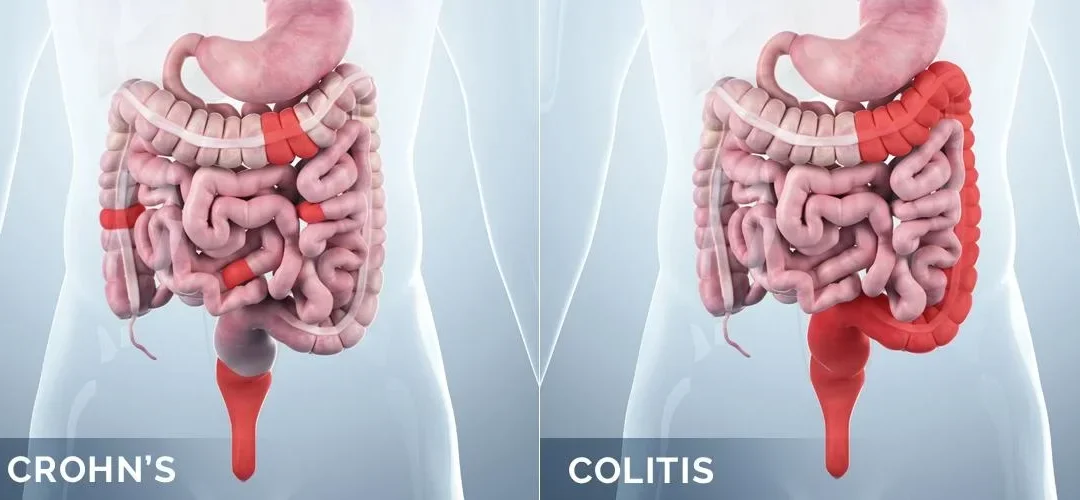 Inflammatory Bowel Disease Treatment Mumbai: Comprehensive Care with Dr. Chintamani Godbole
