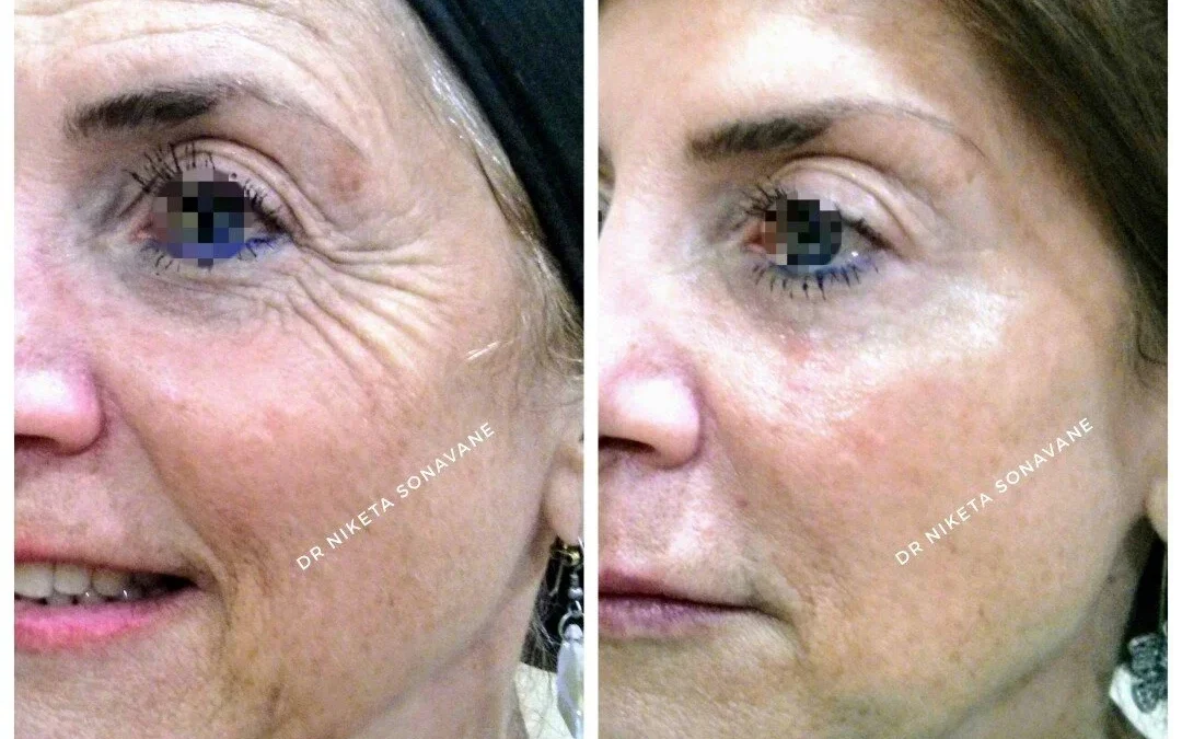 Botox Treatment in Mumbai – Safe, Natural-Looking Results with Dr. Niketa Sonavane