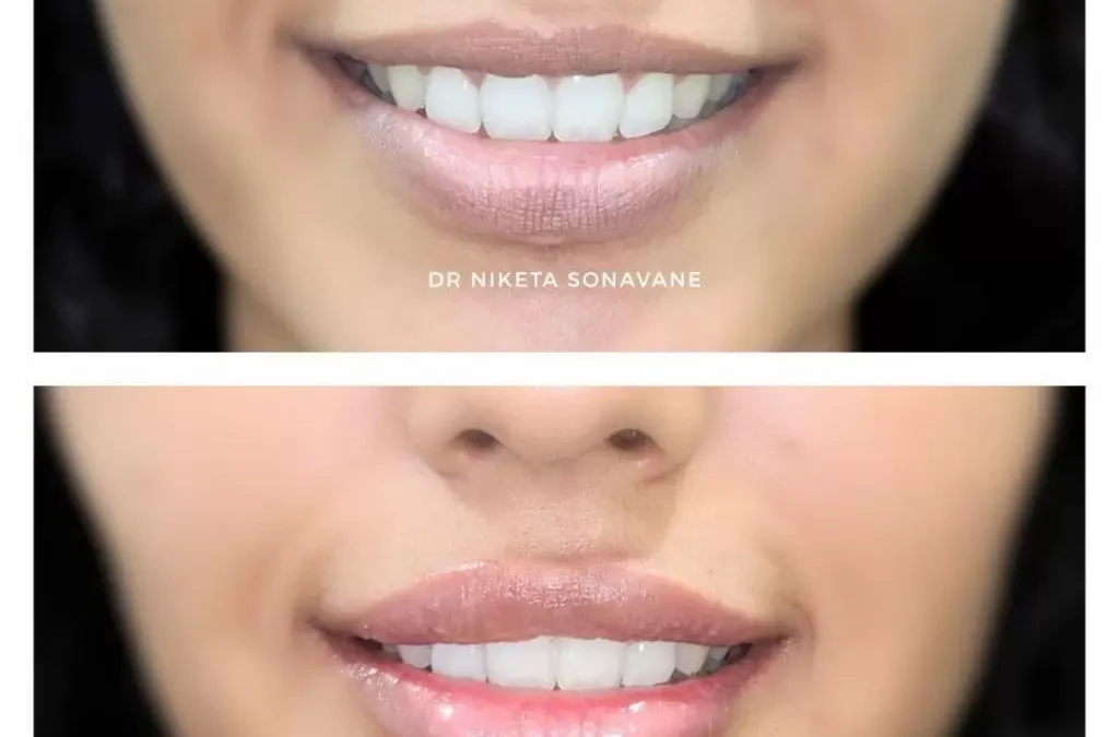 Lip Pigmentation Treatment: Achieve Naturally Bright and Even-Toned Lips