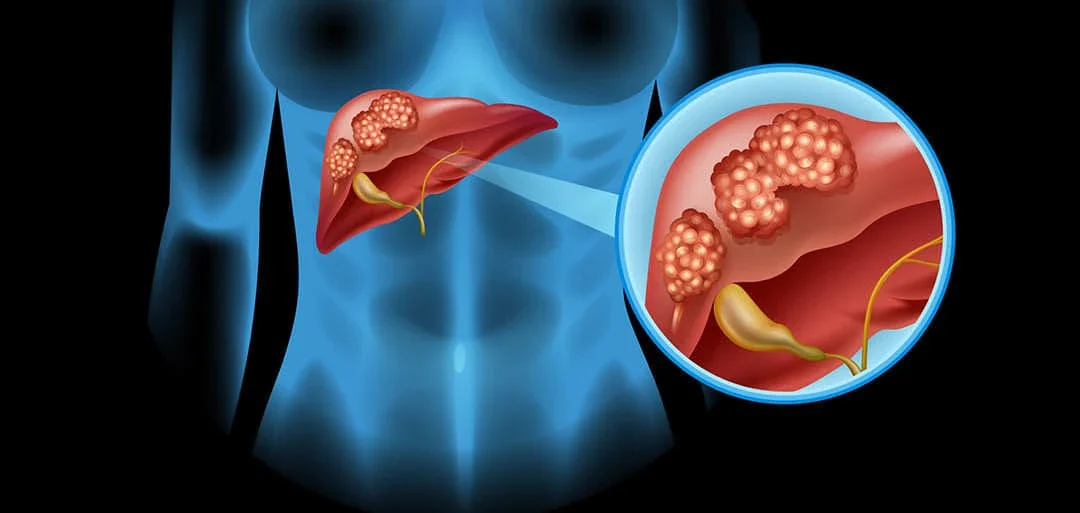 Best Doctor for Liver Cancer in Mumbai: Expert Liver Cancer Care with Dr. Ganesh Nagarajan