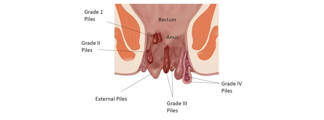 Piles Treatment Mumbai: Advanced Care for Hemorrhoids by Dr. Vedant Karvir