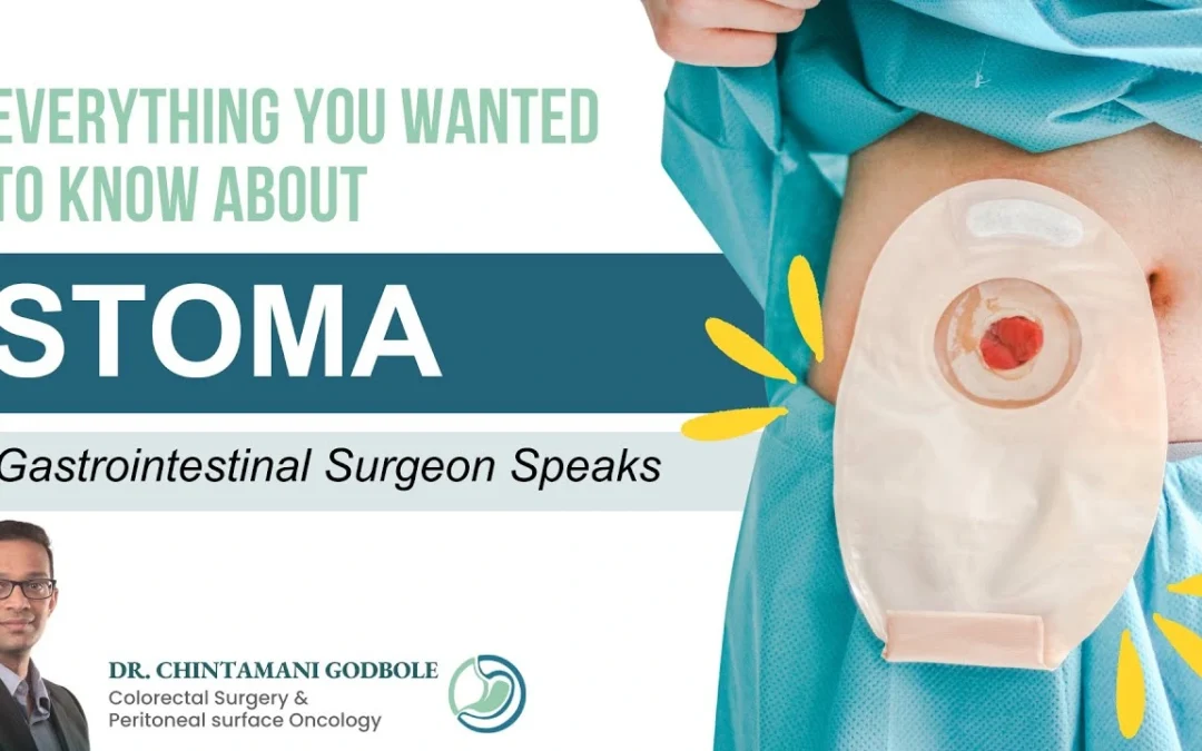 Stomal Therapy: Comprehensive Care for Better Quality of Life After Ostomy Surgery