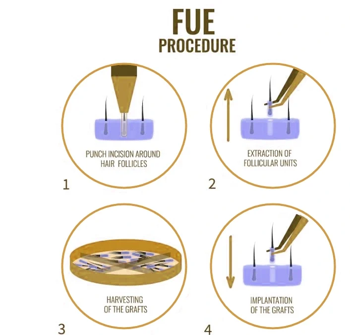 FUE Hair Transplant Mumbai: Achieve Natural Hair Restoration with Dr. Deepam Shah