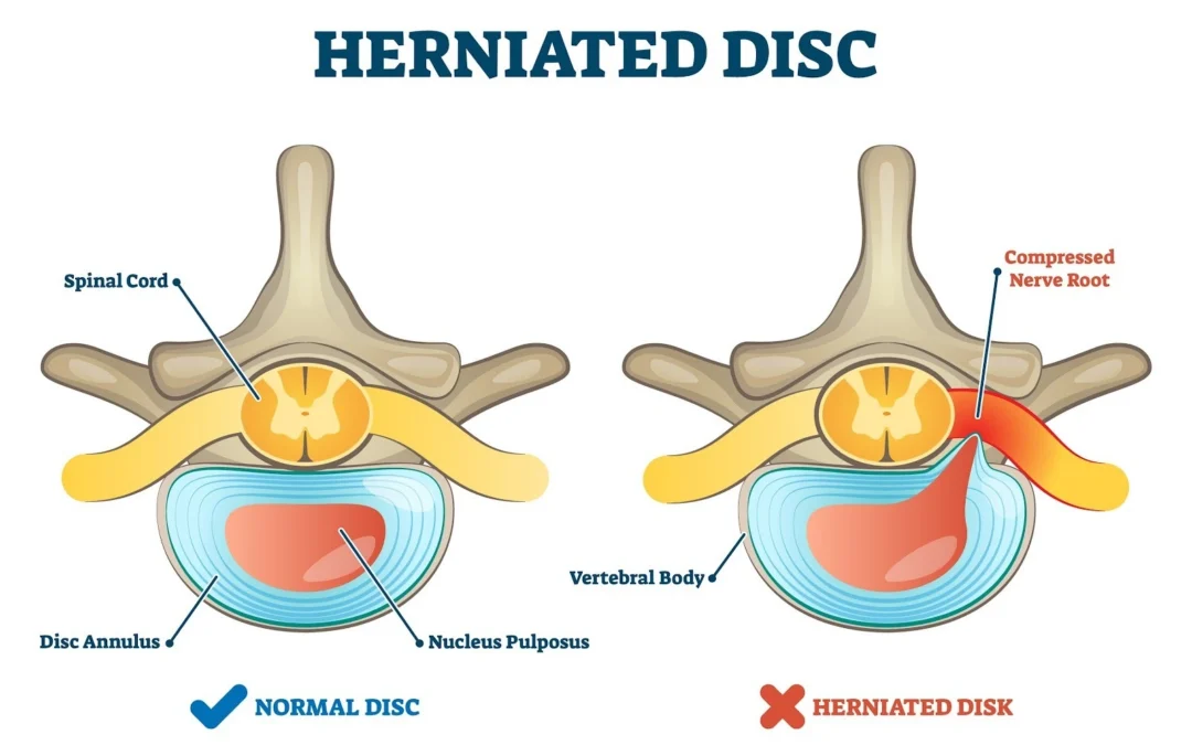 Slipped Disc vs. Bulging Disc – Understanding the Difference with Synapse Spine