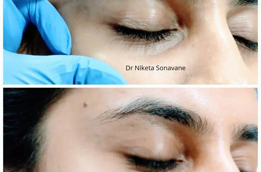 Dermal Fillers for Under Eyes: Restore a Refreshed and Youthful Look with Dr. Niketa Sonavane