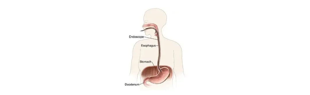 Upper GI Endoscopy Treatment in Mumbai: Procedure, Benefits, Preparation and Expert Care