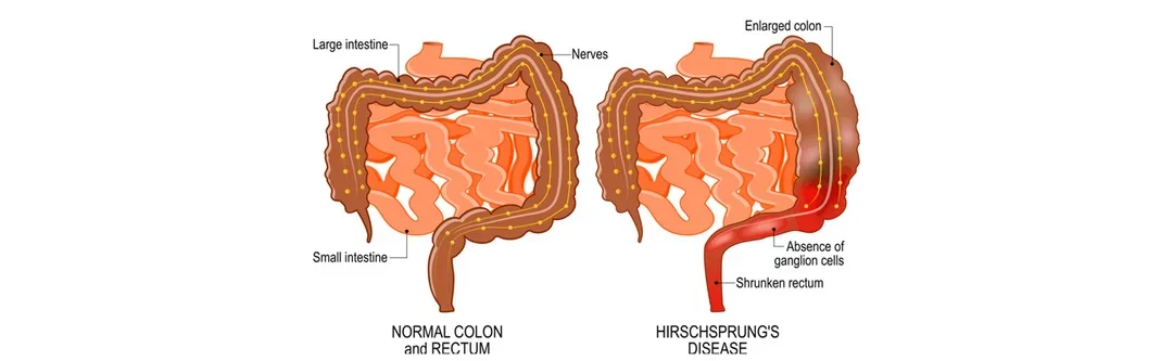 Hirschsprung’s Disease Treatment in Mumbai: Diagnosis & Care