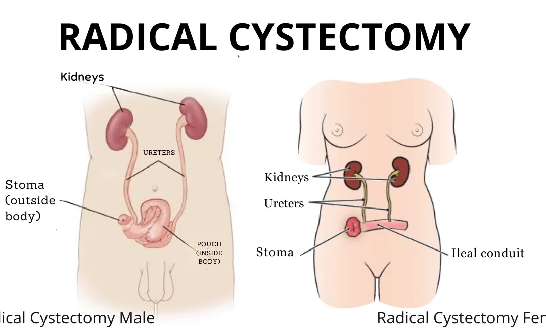 Radical Cystectomy in Mumbai: Procedure, Benefits and Recovery