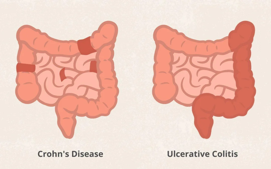 Ulcerative Colitis Treatment in Mumbai: Symptoms, Diagnosis and Care