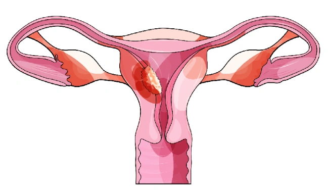 Uterine Sarcoma Surgery in Mumbai: Diagnosis, Treatment and Recovery