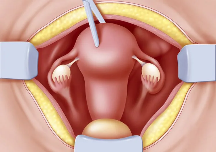 Uterus Removal in Thane: Treatment, Types, and Recovery