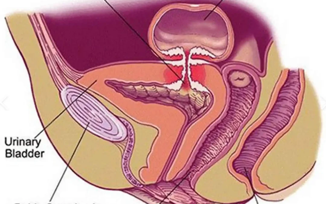 Urinary Fistula Treatment Mumbai: Expert Care by Dr. Vivek Venkat
