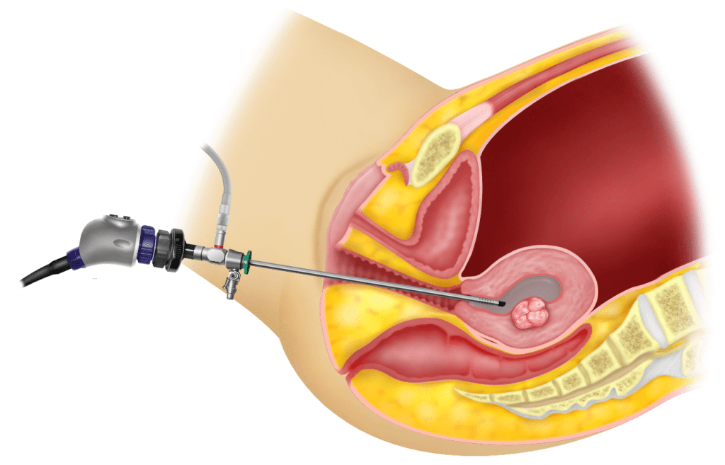 Hysteroscopy Treatment in Thane: Expert Care by Dr. Arohi Tasgaonkar
